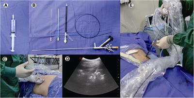 Performing percutaneous nephrolithotomy under modified local anesthesia